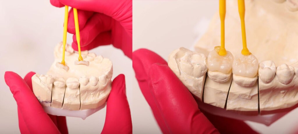 inlay onlay proetetica dentara Iasi, obturatii estetice