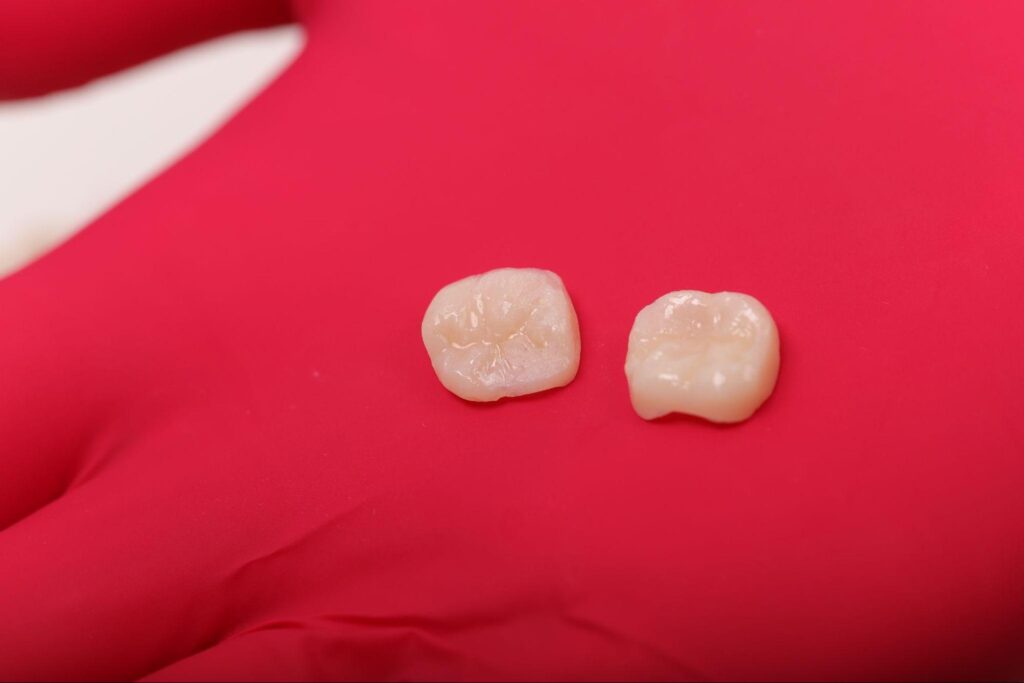 inlay onlay proetetica dentara Iasi, obturatii estetice