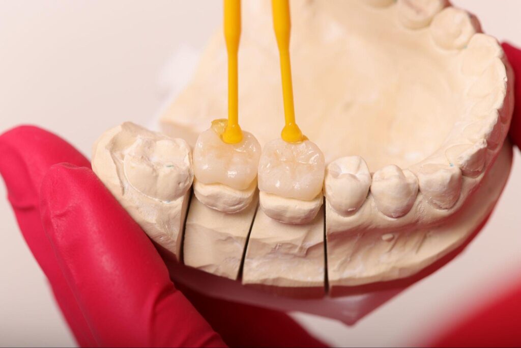 inlay onlay proetetica dentara Iasi, obturatii estetice