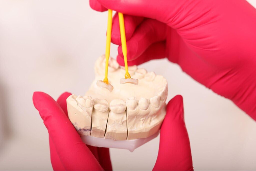 inlay onlay proetetica dentara Iasi, obturatii estetice