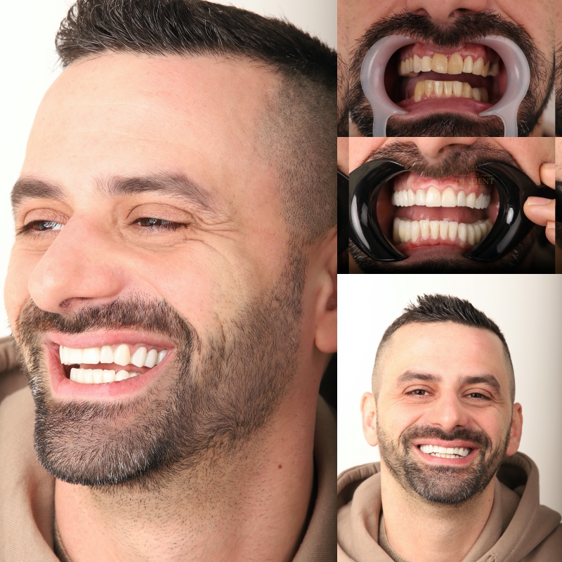 implant dentar Iasi, coroana dentara zirconiu, detartraj Iasi
