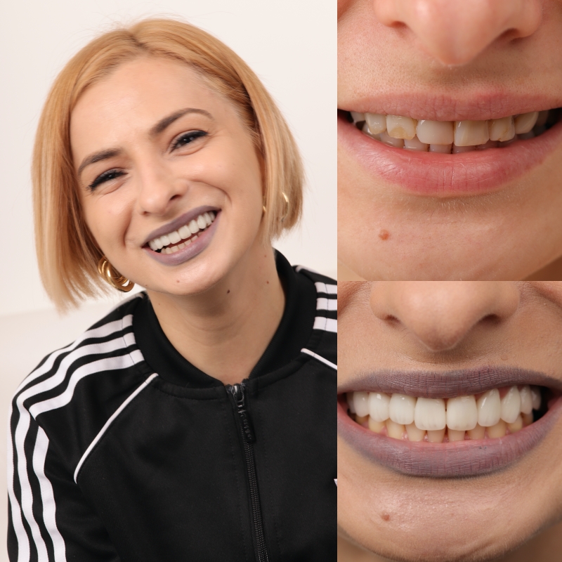 fatete dentare iasi, coroane dentare Iasi, protetica