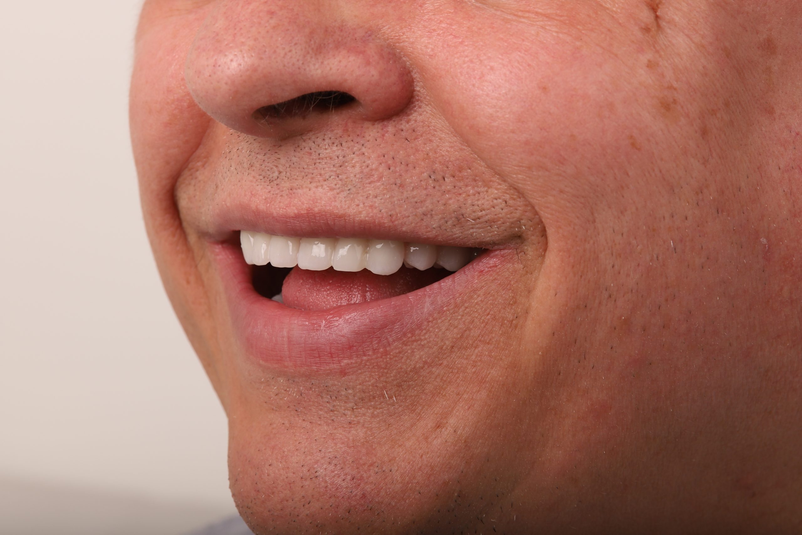 proteza pe implant Iasi, proteza dentara, protetica