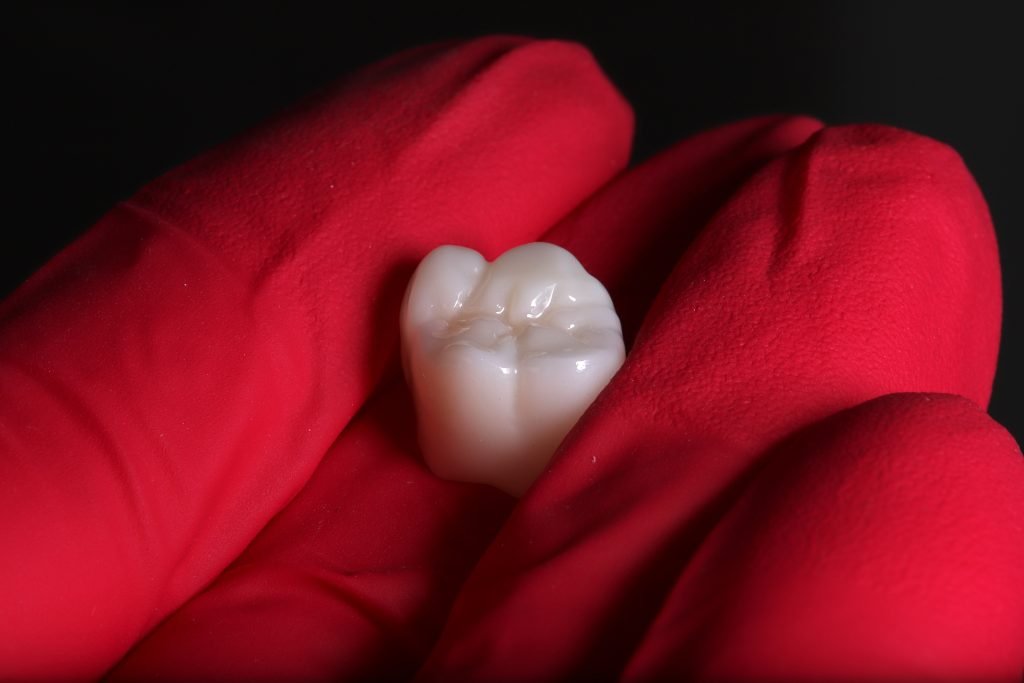 coroana dentara Iasi, fatete dentare Iasi, estetica dentara