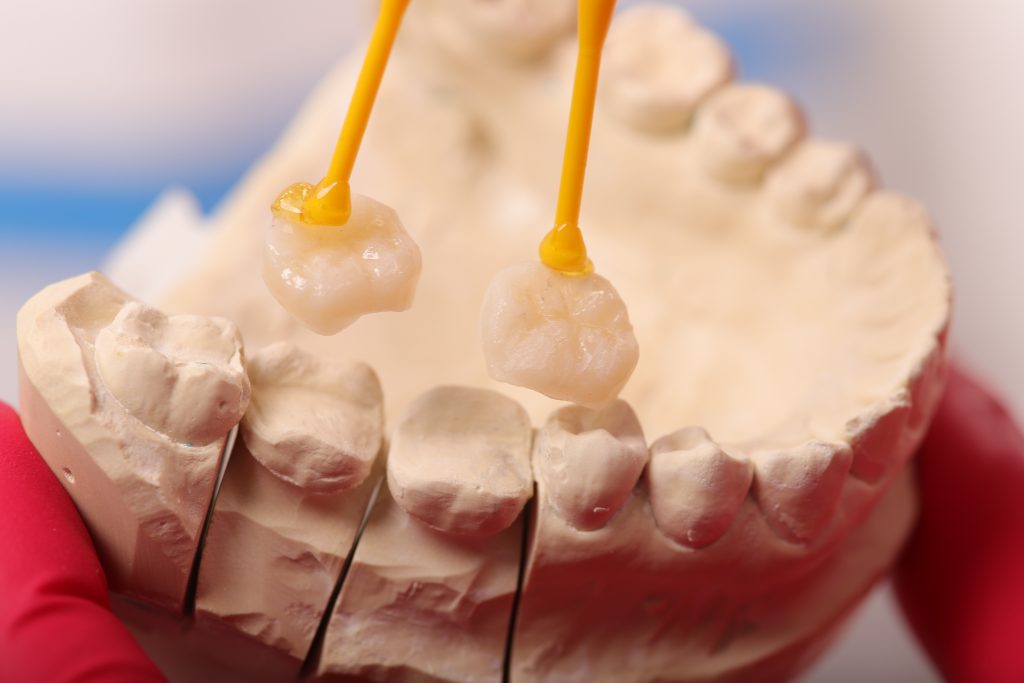 incrustatii dentare Iasi, inlay onlay Iasi