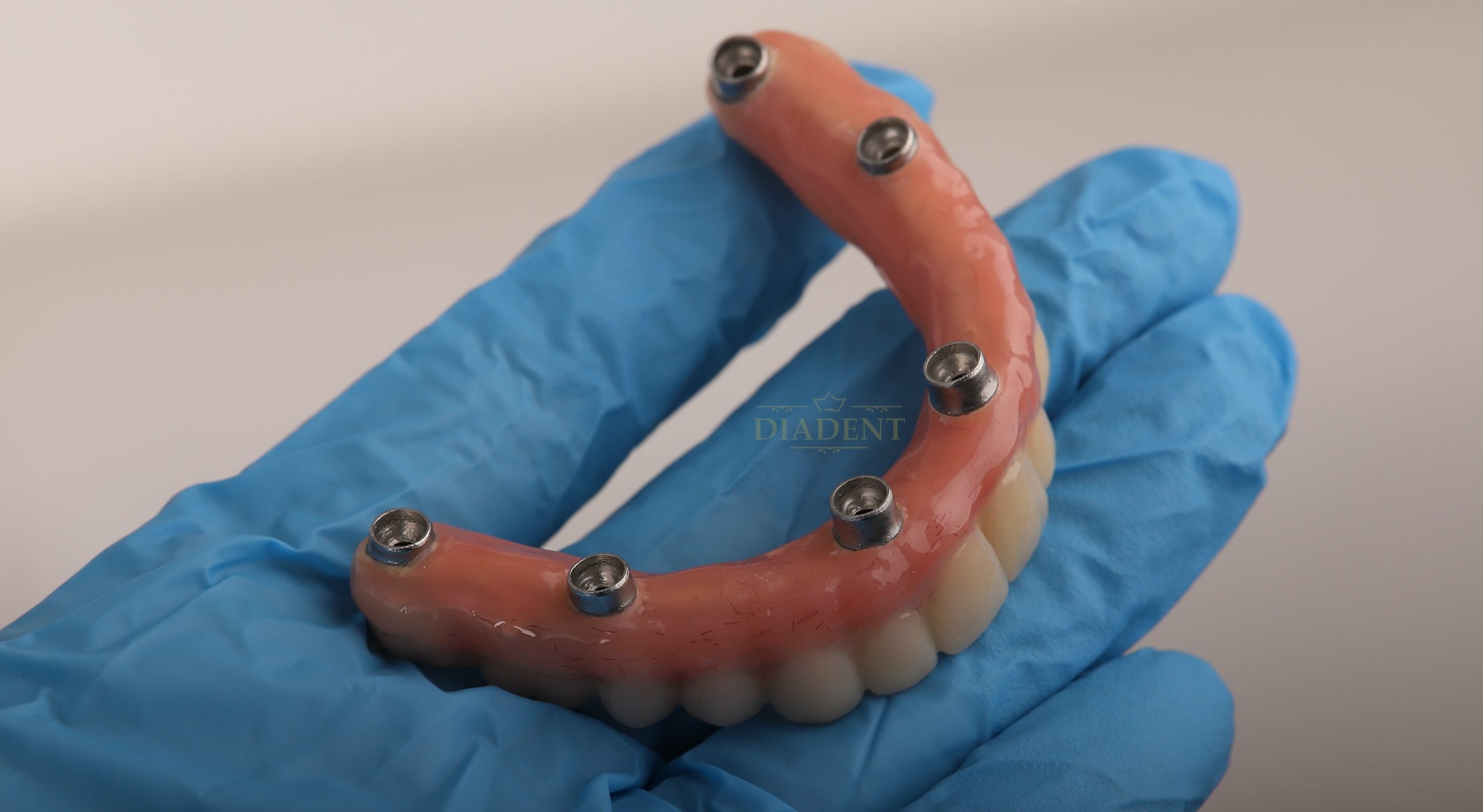 proteza dentara Iasi, coroana dentara zirconiu