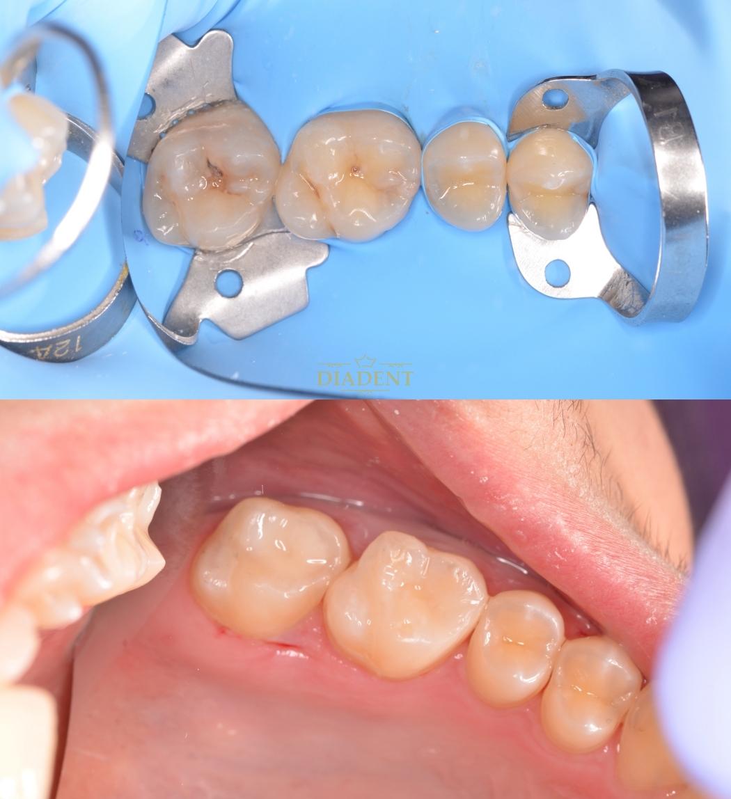 tratament enddontic Iasi, endodontie Iasi