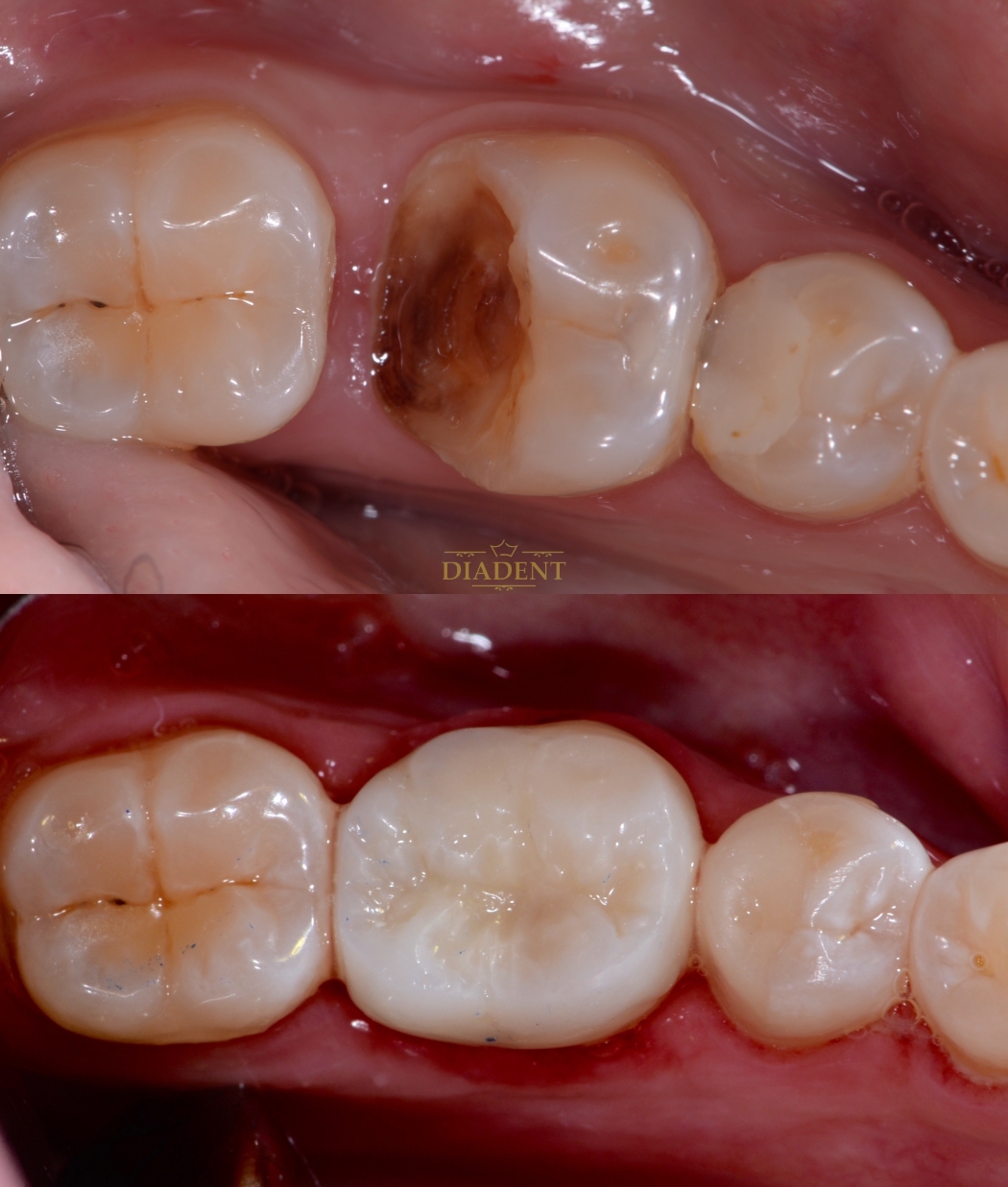 tratament enddontic Iasi, endodontie Iasi