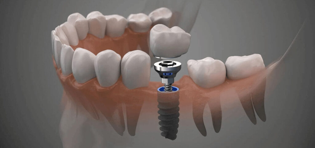 implant dentar Iasi, stomatologie Iasi, tratamente dentare