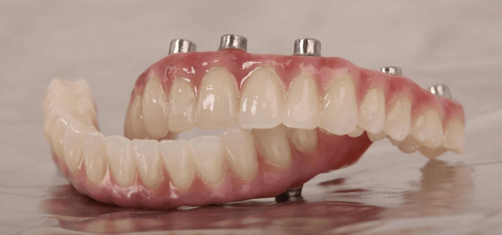 stomatologie Iasi, tratamente dentare, implant dentar Iasi, coroana dentara, fatete