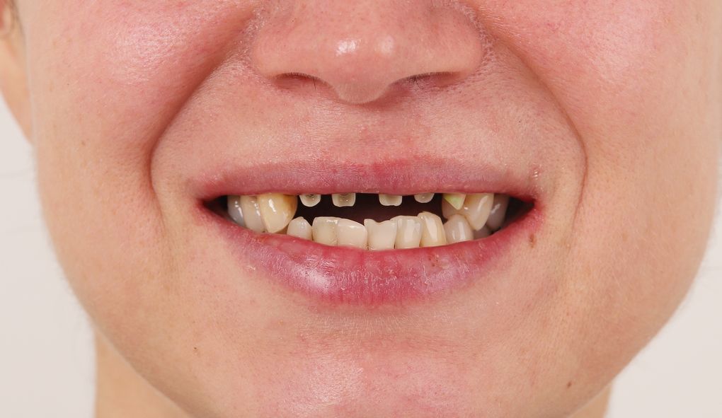 caz pacient implanturi dentare Iasi - BEFORE